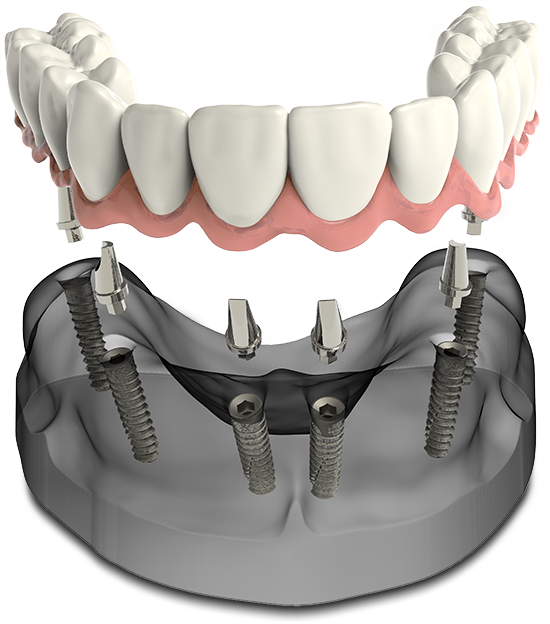 full arch of missing teeth