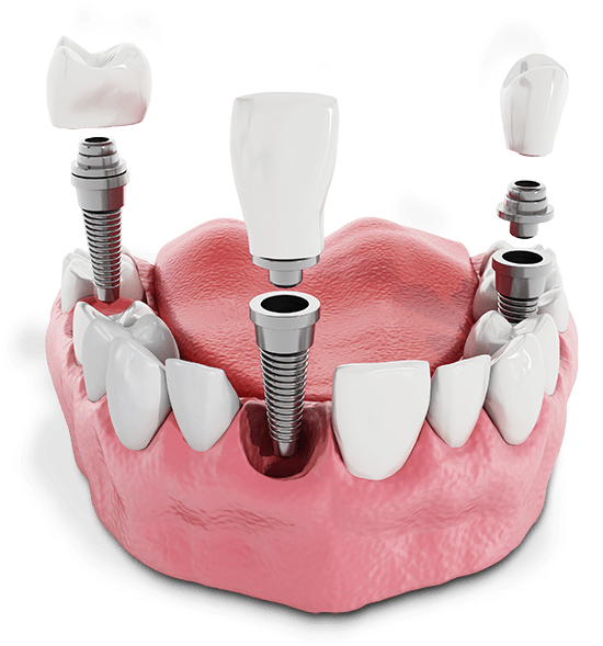 Multiple Dental Implants In Gumline